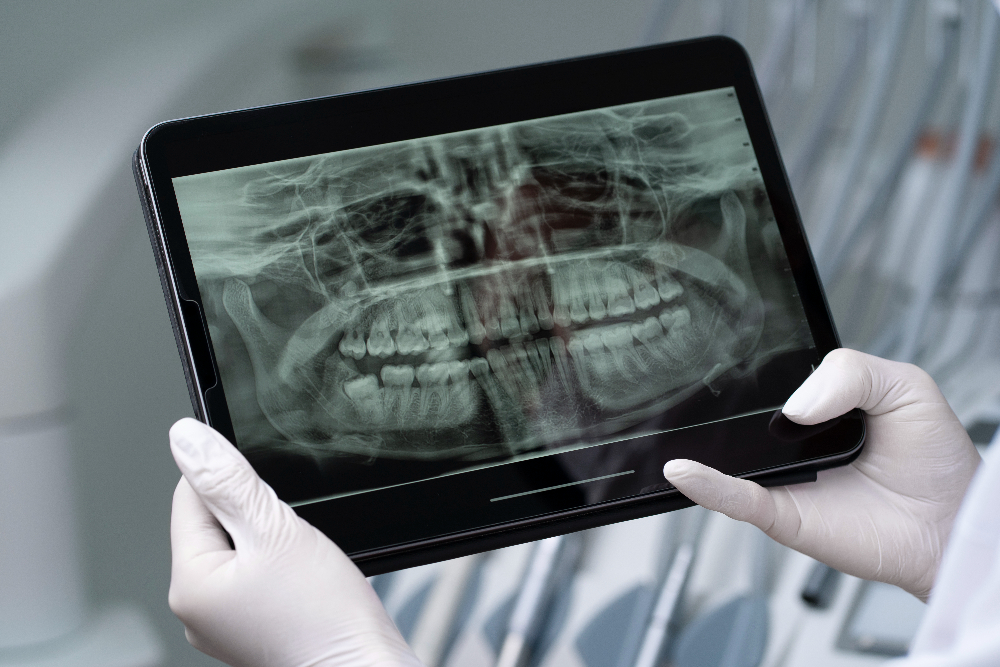 Digital X-ray